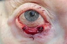 mohs chirurgie voor basaalcelcarcinoom op het ooglid